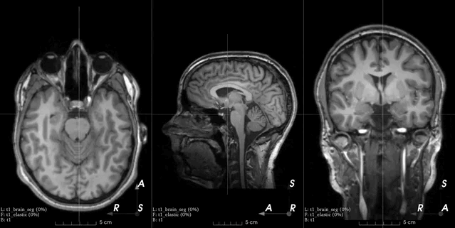 Introduction to TorchIO for 3D MRI Processing