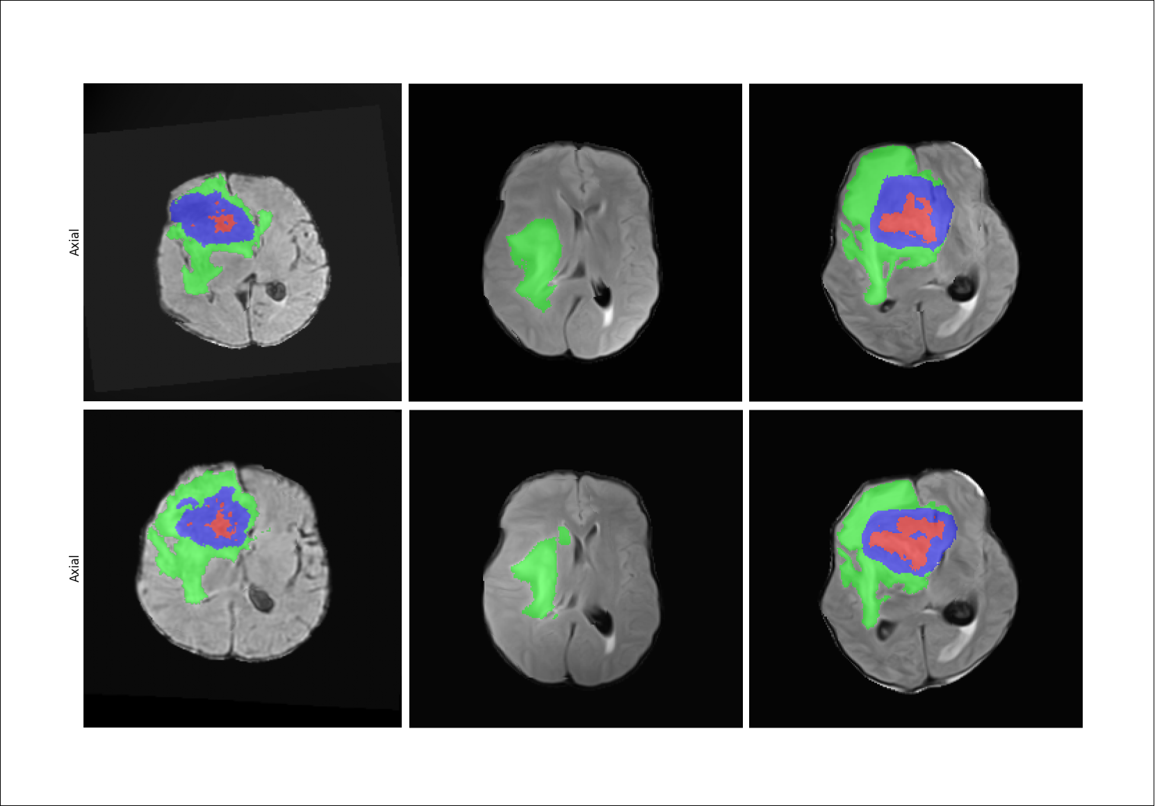 How We Won BraTS-SSA 2025